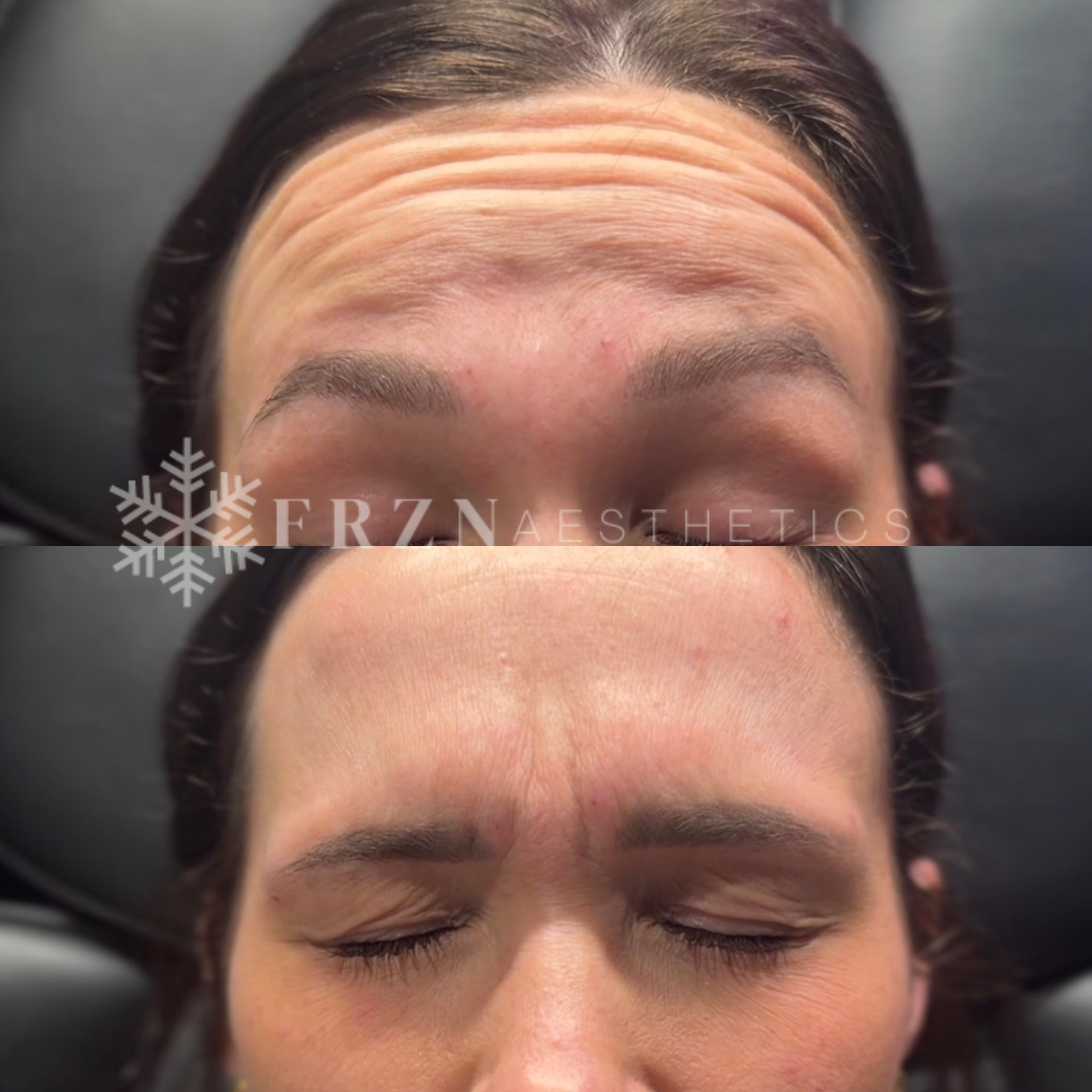Botox_Daxxify_FRZN_Aesthetics_Before_Frisco_Texas