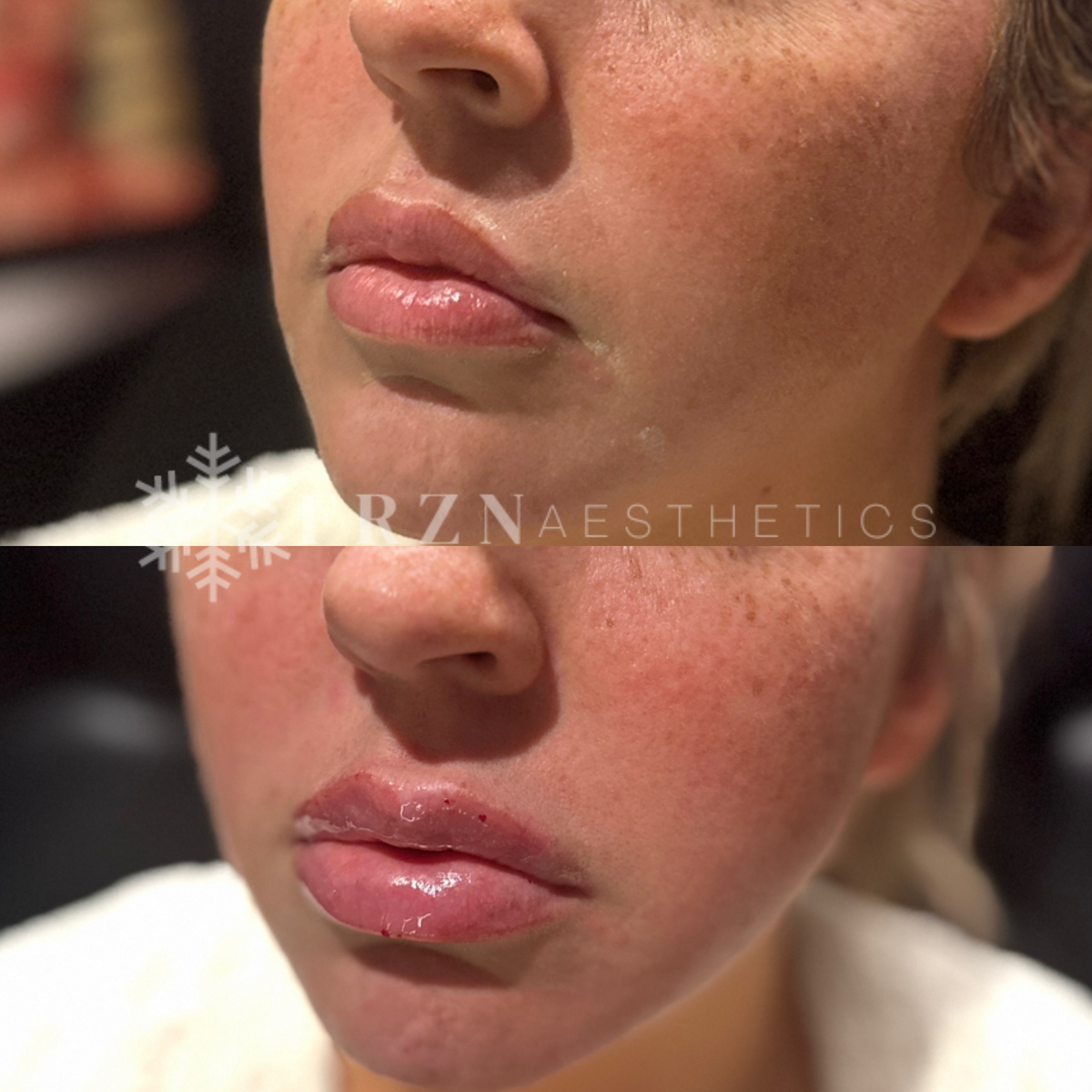 FRZN Before and After Lip Filler 4 Frisco Texas
