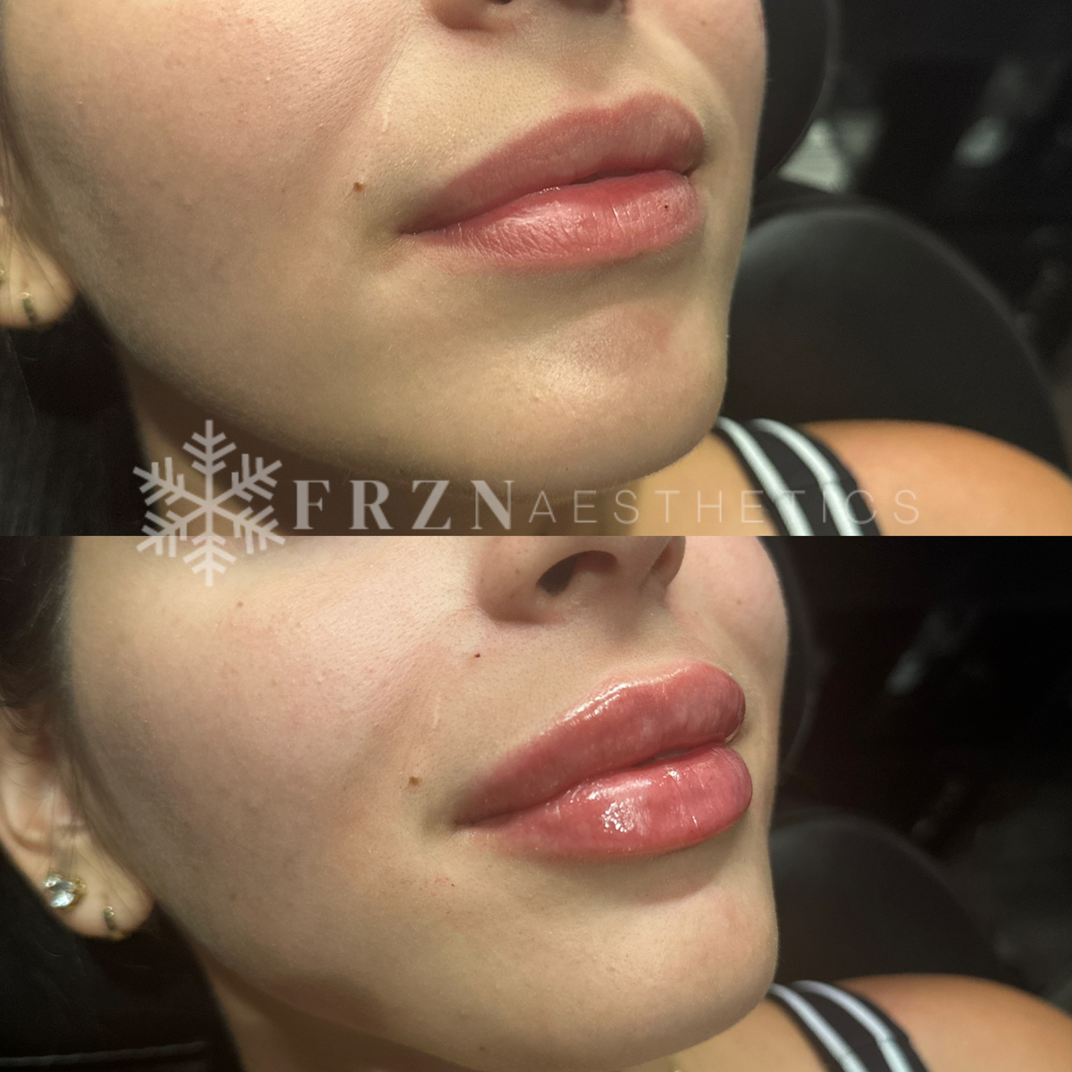 FRZN Before and After Lip Filler 5 Frisco Texas