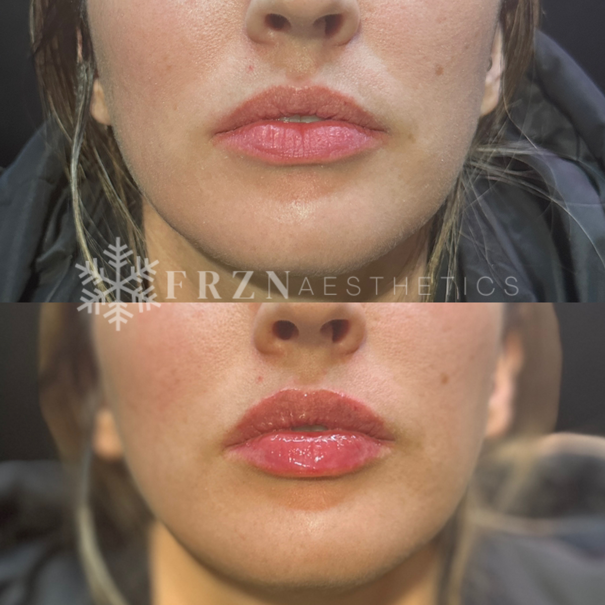 Before and after lip filler 3 by FRZN Aesthetics in Frisco, Texas