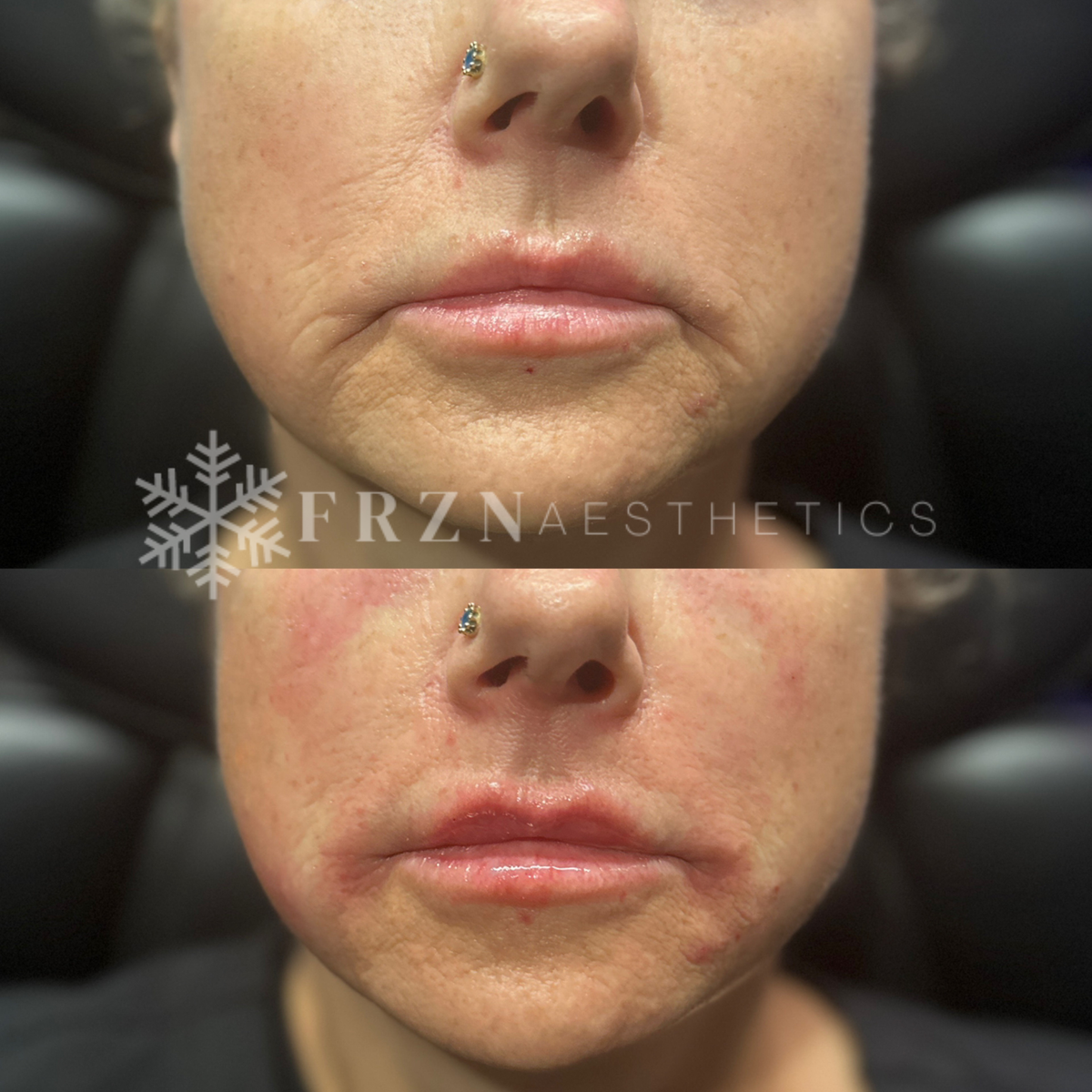 Before and after Marionette Lines EZ Gel treatment by FRZN Aesthetics in Frisco, Texas.