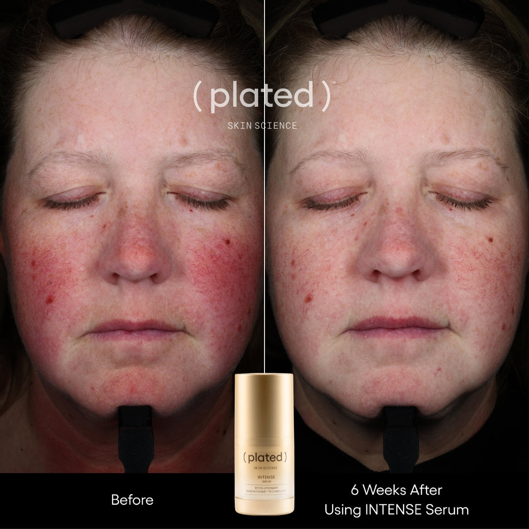 Plated INTENSE Serum, before and after results, at FRZN Aesthetics in Frisco, TX
