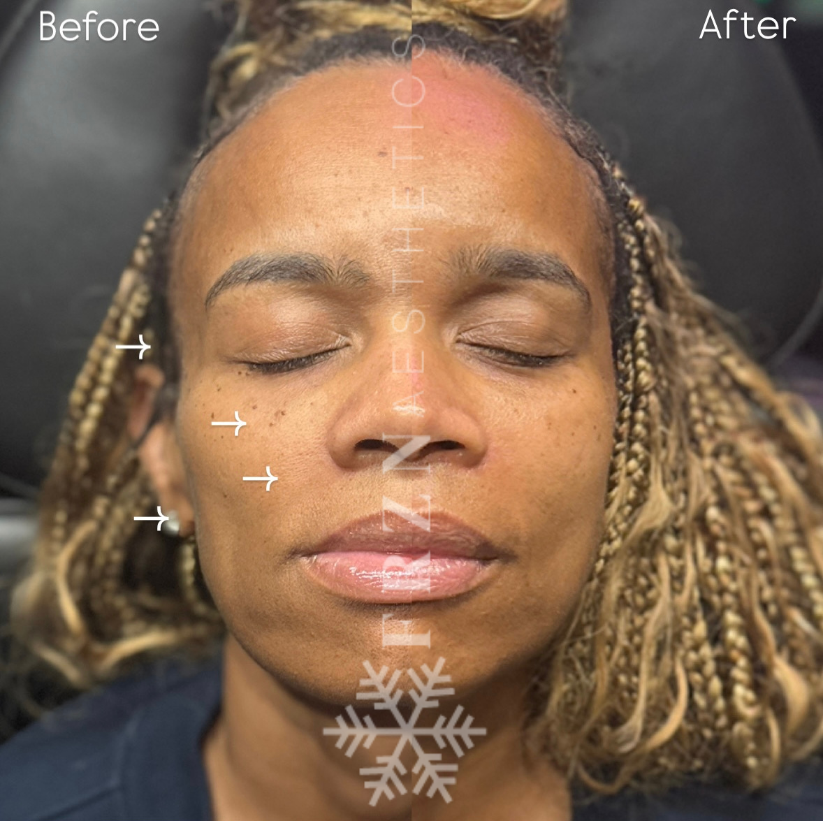 Before and after full face Sculptra treatment at FRZN Aesthetics in Frisco, TX
