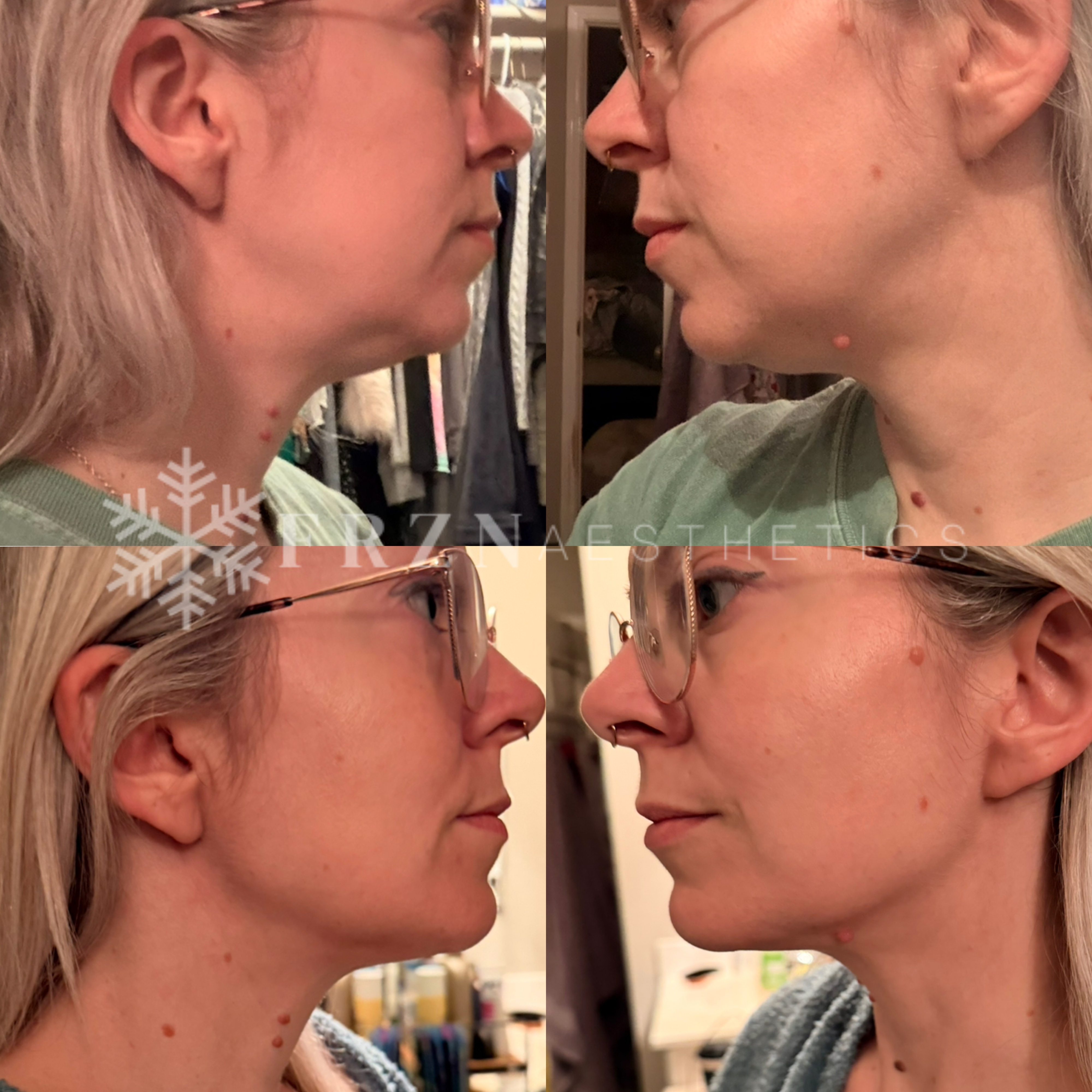 Before and after neck and jawline sculpting results by FRZN Aesthetics in Frisco, Texas