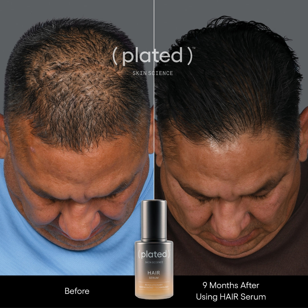 Plated HAIR Serum, before and after results, at FRZN Aesthetics in Frisco, TX