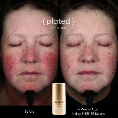 Plated INTENSE Serum, before and after results, at FRZN Aesthetics in Frisco, TX
