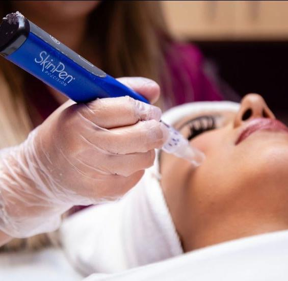 SkinPen microneedling for acne scarring and wrinkles at FRZN Aesthetics in Frisco, Texas