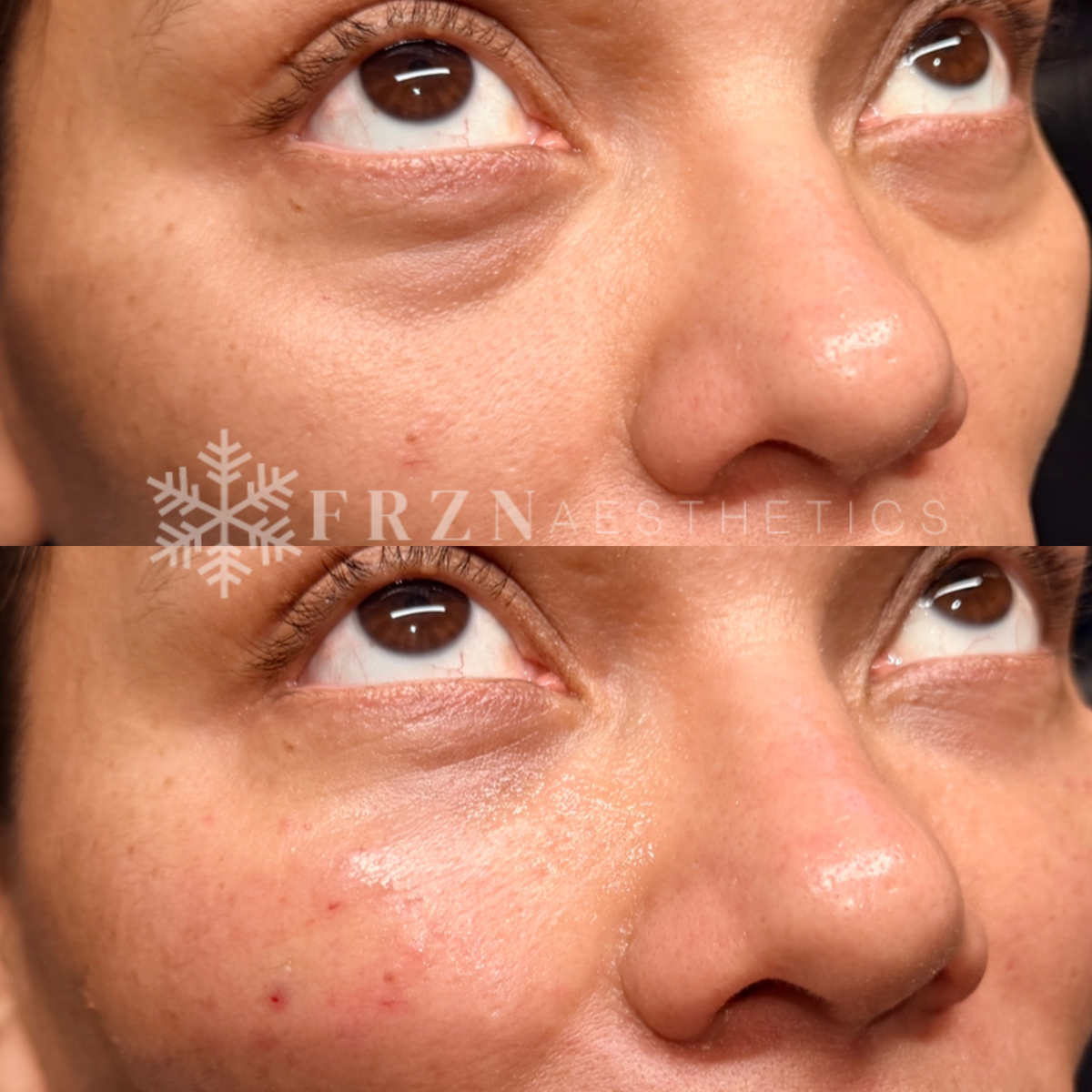 Before and after Undereye Tear Trough  EZ Gel treatment by FRZN Aesthetics in Frisco, Texas.