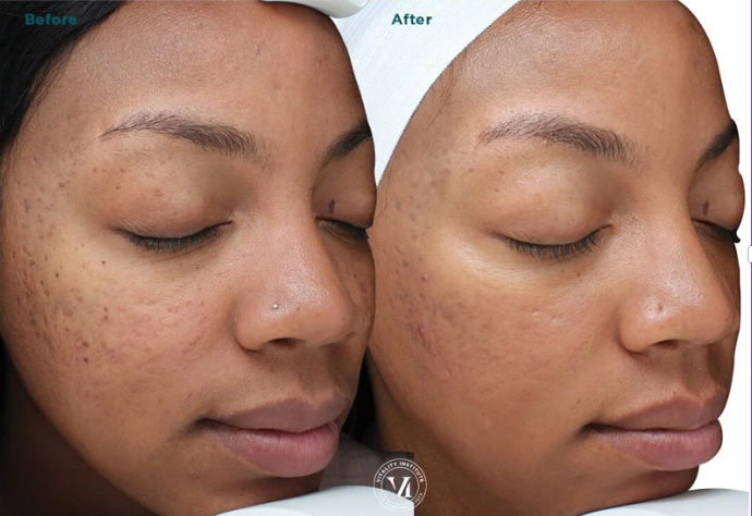 Before and after Vi Peel chemical peel results improving tone and pigment on deeper skin at FRZN Aesthetics in Frisco, Texas