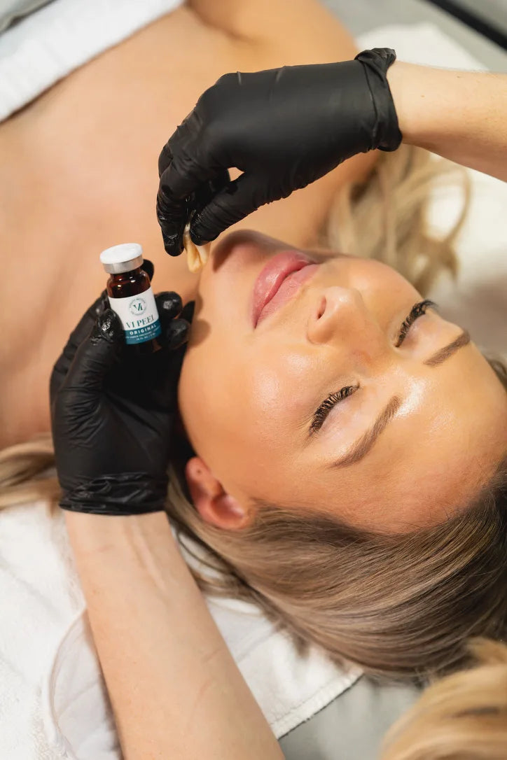 Vi Peel chemical peel solution being applied by FRZN Aesthetics in Frisco, Texas