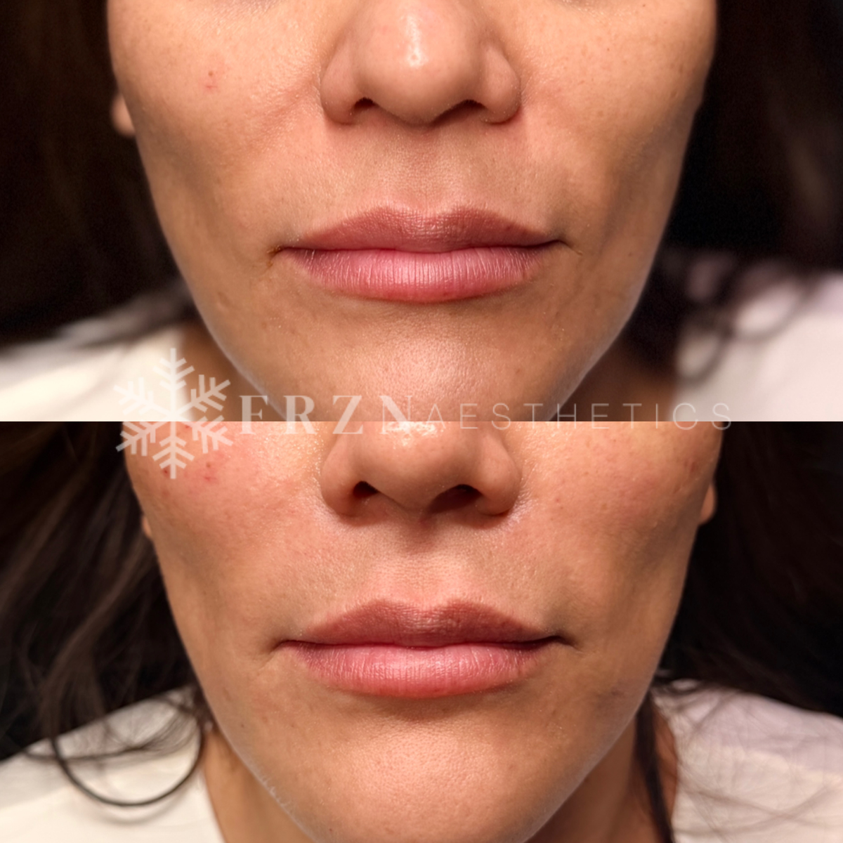 Before and after Nasolabial fold EZ Gel treatment by FRZN Aesthetics in Frisco, Texas.