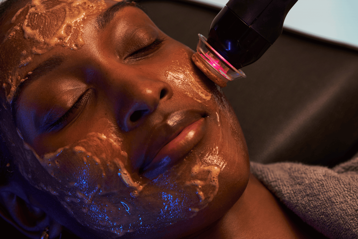 Oxy2 Glo2Facial treatment performed on deeper skin tone at FRZN Aesthetics in Frisco, TX